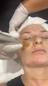 How to get rid of dark spots?