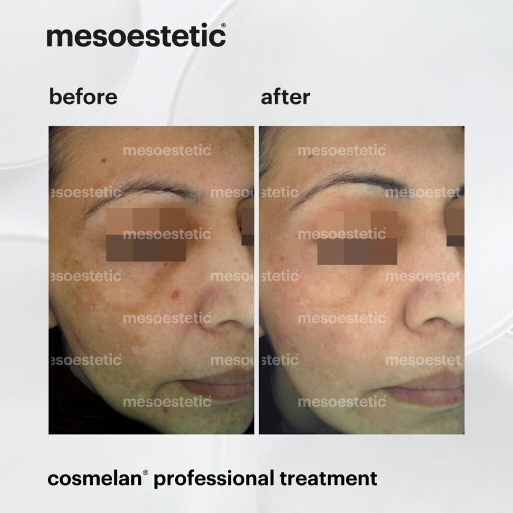cosmelan depigmentation treatment