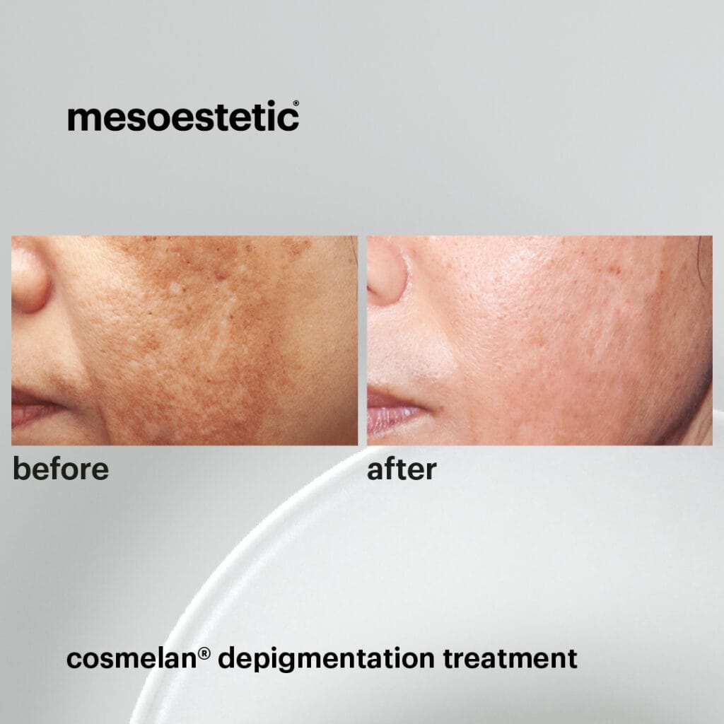 cosmelan depigmentation treatment